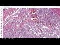 Bone & Soft Tissue Pathology Board Review: 20 Classic Cases (McGill pathology residents)