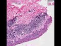 Histopathology Skin--Mycosis fungoides