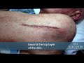 Melanoma Excision & Scars Left Behind | David Bushore, M.D. | Austin, TX | Ph: 512-459-4869