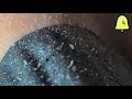 Blackhead removal| #Peeloffmask| Disgusting yet #satisfying|Enjoy 😃oozy whiteheads|#skincare