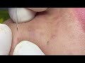 Acne treatment for Spa Linh Mun 2024 #111
