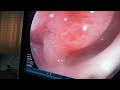 Pedunculated Polyp