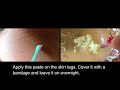 Remove Skin Tags | Home Remedies To Remove Skin Tags Easily