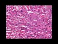 Histopathology Skin--Dermatofibroma