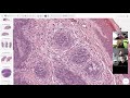 Trichoepithelioma 101