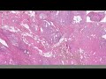 Hashimoto Thyroiditis - Histopathology