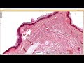 Scar with injected steroids (Kenalog triamcinolone) pathology dermpath dermatology dermatopathology