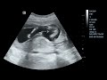 12 weeks ultrasound | Guess the gender !