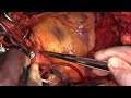 Heart Transplant Surgery | Anthony Zaki, MD (Graphic)