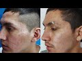 🔥 El MEJOR TRATAMIENTO para CICATRICES DE ACNE y otras 2021✅ DERMAPEN + SUBCISION / ANTES Y DESPUES