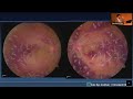 Organ-specific issues in vasculitis