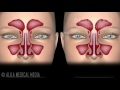 Sinusitis, Animation.