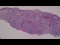 Atypical fibroxanthoma (AFX) vs mimics (spindle cell melanoma, squamous cell carcinoma, etc)