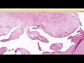 Rapid Board Review: Cysts & Benign Epidermal Lesions (Dermpath Dermatology Pathology)