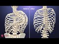 고려대학교 구로병원 척추절골술 3D 영상