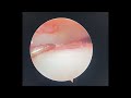Arthroscopic Surgical Treatment of Talus Osteochondral Lesion with Arthrex BioCartilage